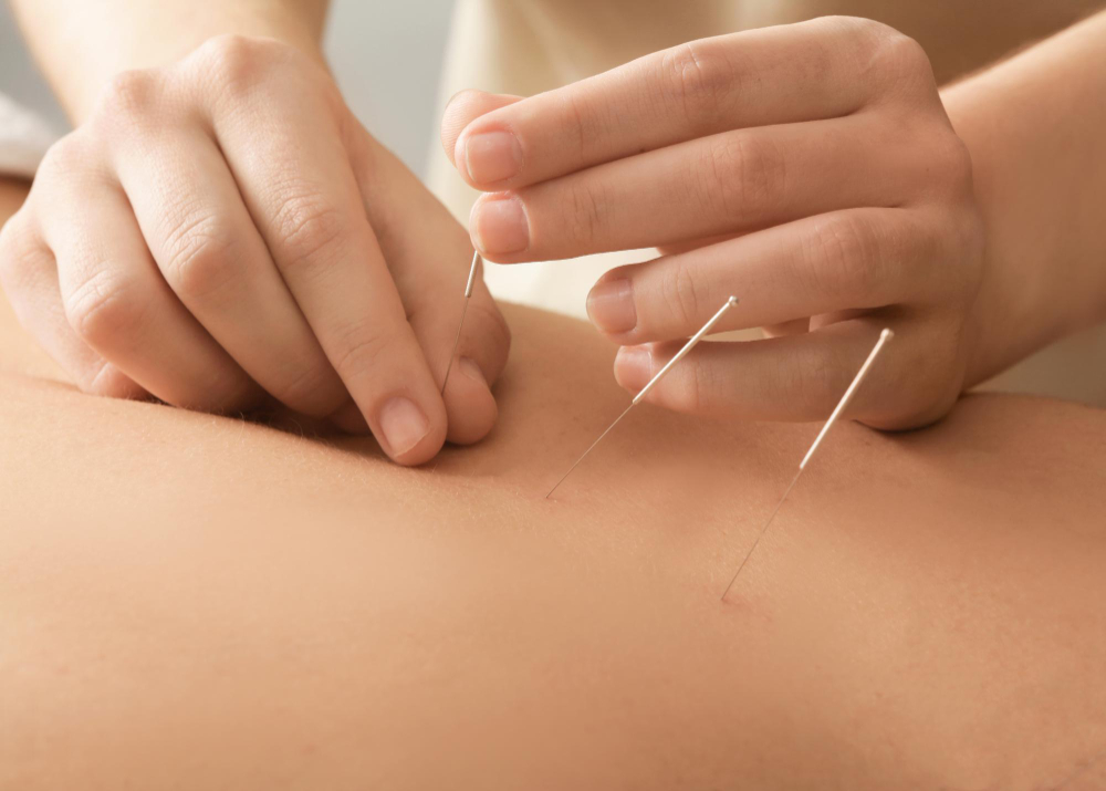 young-man-getting-acupuncture-treatment-closeup
